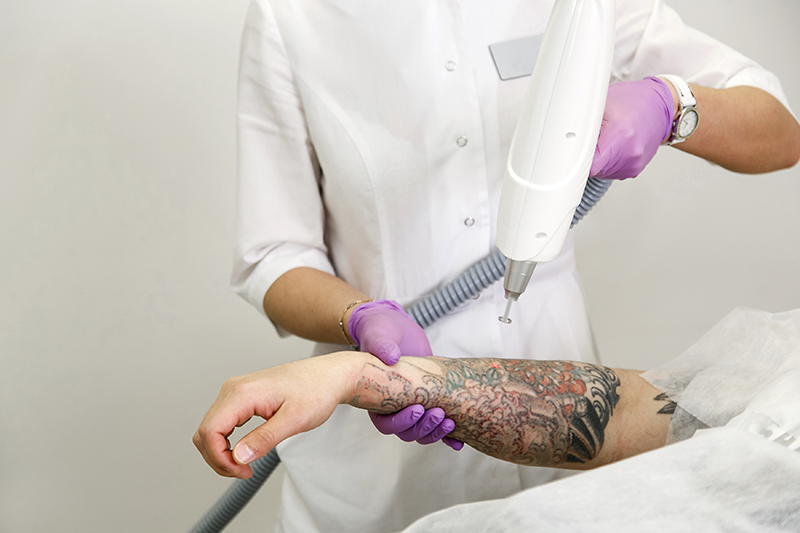 usuwanie tatuażu stalowa wola